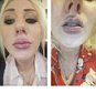 MODEL KEEN TO EMULATE KYLIE JENNERíS FULL LIPS WARNS OF THE DANGERS OF DIY LIP ENHANCEMENT AFTER DISASTROUS ATTEMPT LEFT HER WITH SEVERE BRUISING. GAIL SCOTT, 25, COULDNíT AFFORD INJECTABLE FILLERS SO TRIED TO CREATE FULLER LIPS WITH HOMEMADE VERSION OF A POPULAR LIP ENHANCER TOOL. BUT THE PART TIME MODEL FROM SALISBURY WAS LEFT WITH PAINFUL BRUISING THAT SHE SAYS MAKES HER LOOKS AS IF SHEíS BEEN PUNCHED AND HAS BEEN UNABLE TO MODEL SINCE. SHE SAYS SHE WAS LUCKY NOT TO BURST A BLOOD VESSEL IN HER LIPS OR MOUTH.  SHE POSTED A WARNING ON FACEBOOK TO DISCOURAGE OTHER YOUNG WOMEN AS THE CRAZE FOR DIY LIP JOBS SWEEPS SOCIAL MEDIA. Pictures of bruising to Gail Scotts lips, after her DIY lip job.Picture: www.photo-features.co.ukMobile: 07966 967672email: jeremy@durkinphotoservices.com41 Boat Dyke RdUptonNorwichNorfolkNR13 6BL