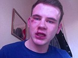 The teenager posted photographs of his injuries online, describing what he said had been an 'utterly inhumane attack'