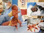 Amanda Arnold gave birth to 'mono mono' twin girls on Thursday - a week after another woman at the same Ohio hospital gave birth to mono mono twin girls