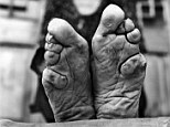 Status symbol: Once a symbol of beauty and status, foot binding, also known as lotus feet, was carried out in China since the 10th century, falling out of favour in the early 20th century before it was outlawed in 1911